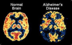 Coffee reduces chances of Alzheimer’s