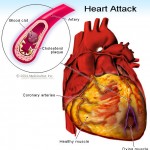 Causes of heart attack