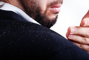 Get Rid of Dandruff